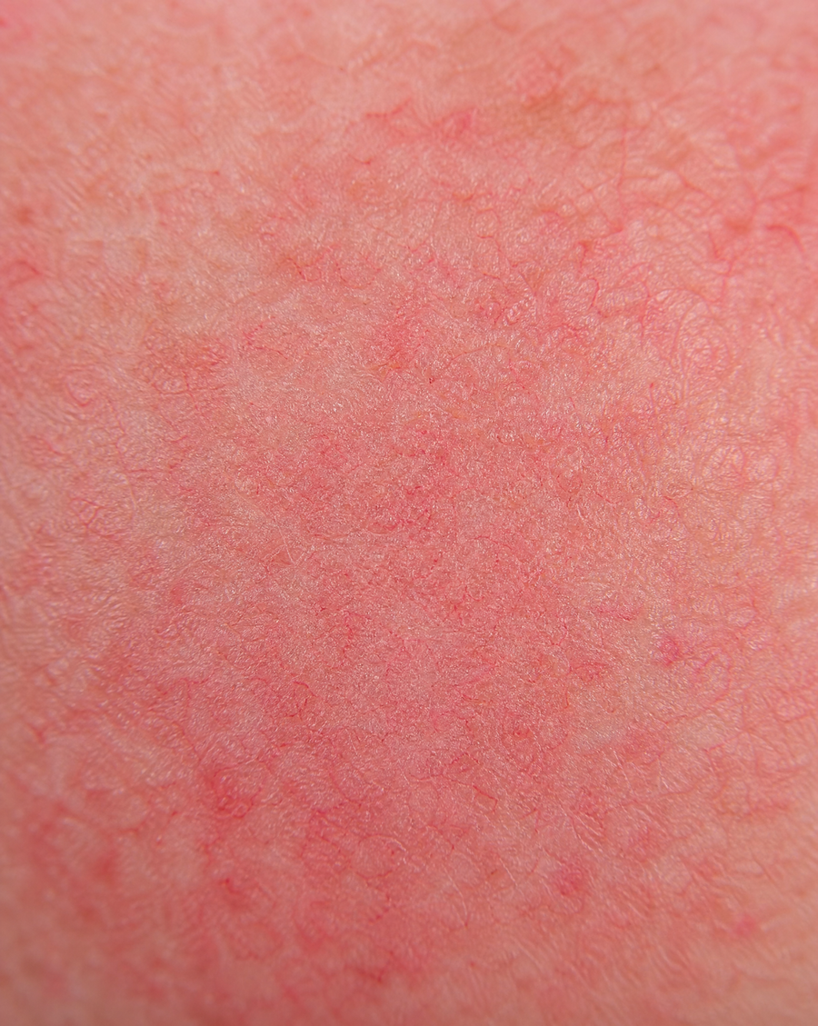 Before illustration - Redness & Rosacea