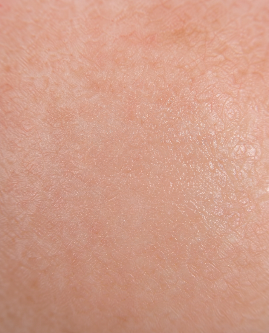After illustration - Redness & Rosacea