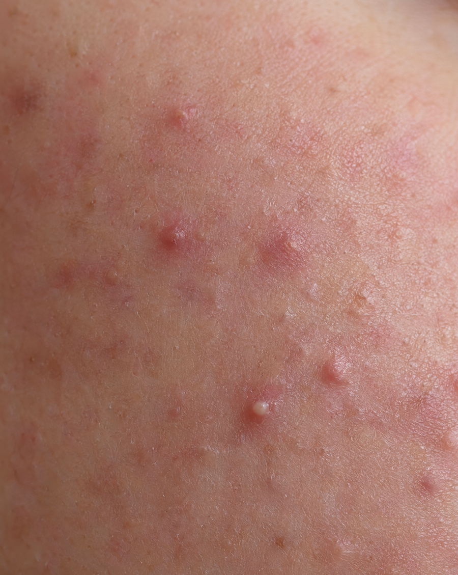 Before illustration - Acne & Breakouts