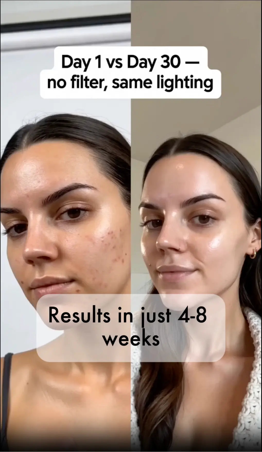 Veloriskin LED Light Therapy Mask + FREE Neck Piece + FREE Serum